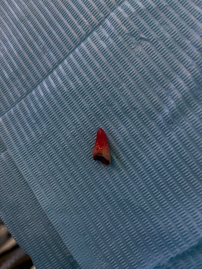 An extracted tooth on a dental bib