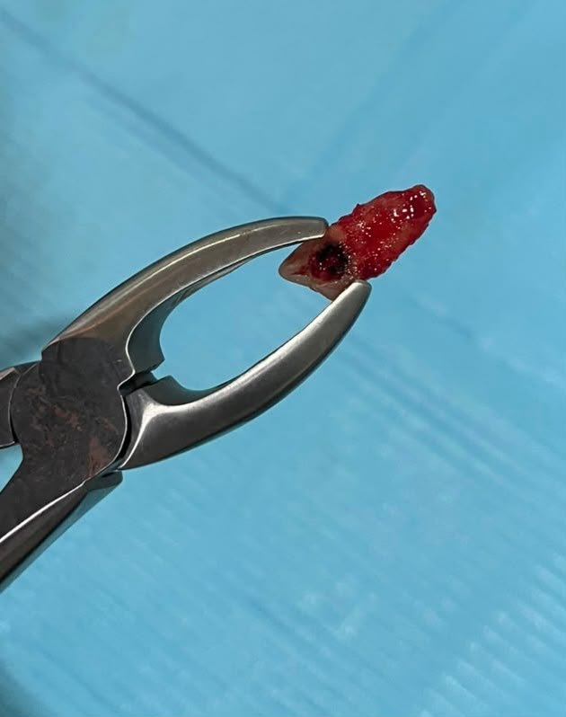 An extracted tooth held in dental forceps