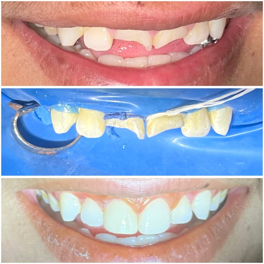 Broken front teeth before, during and after restoration