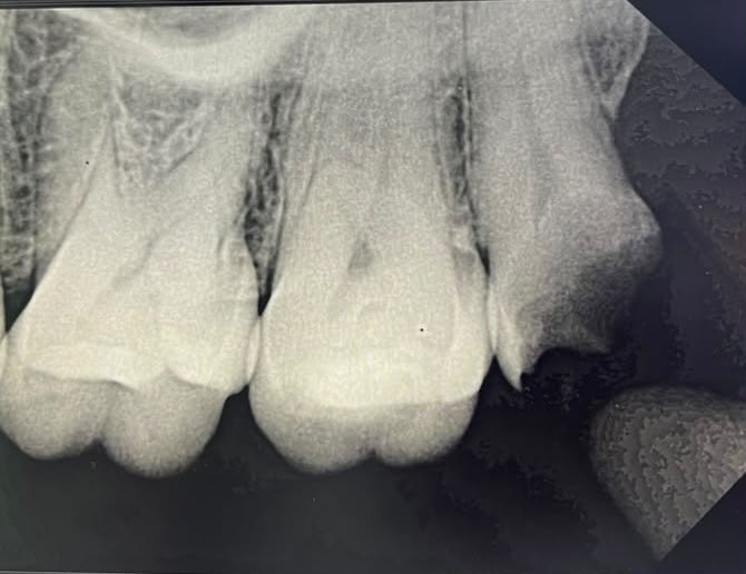 Dental X-ray of upper back teeth